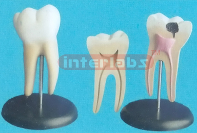 GIANT HEALTH AND CARIES MOLAR MODEL, (2 PCS) ON BASE